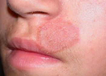 Bệnh hắc lào: Nguyên nhân phương pháp điều trị và phòng ngừa bệnh